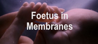 Foetus in Membranes