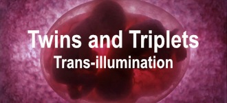 Twins and Triplets T-I